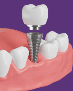 services-implants
