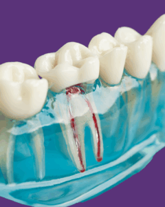 services-root-canal