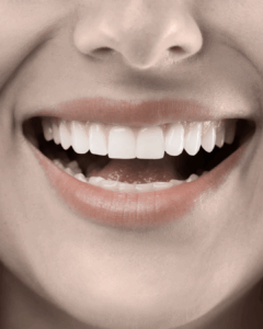 services-veneers