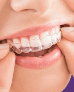 servises-invisalign